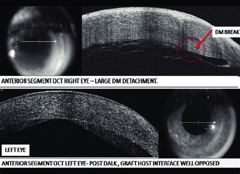 Anterior Segment Optical Coherence Tomography Showing Descemets Break Download Scientific