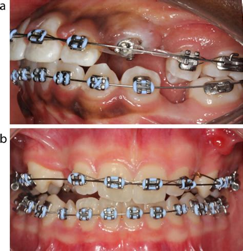 Stainless Steel Ligatures In Orthodontic Treatment Orthodontic Update