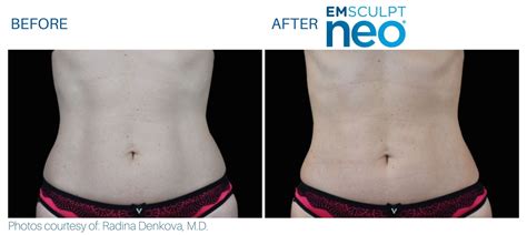 Emsculpt NEO Body Sculpting Grace Gynecology Wellness