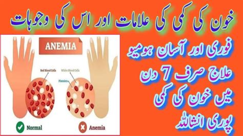 Anemia Homeopathic Treatment And Tips خون کی کمی کی وجوہات علامات