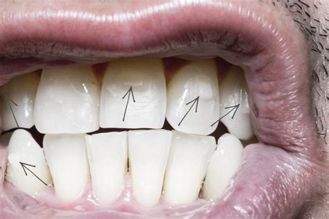 Ataches En Invisalign Qu Son Y Para Qu Sirven Imaxilodental