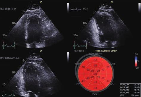 Deformation Imaging Method Showing Regional Hypokinesis Mainly In The Download Scientific