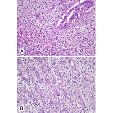 A Benign Breast Duct With Cellular Stroma Hande ×20 B Stromal