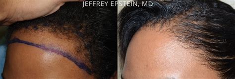 Hair Transplants For Women Photos Miami Fl Patient42143