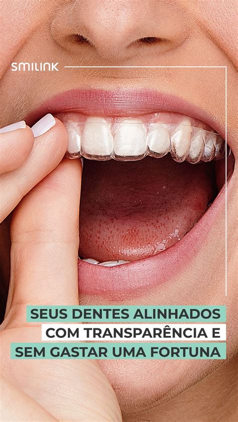 Dentes Alinhados Em Cerca De 7 Meses Aparelho Transparente