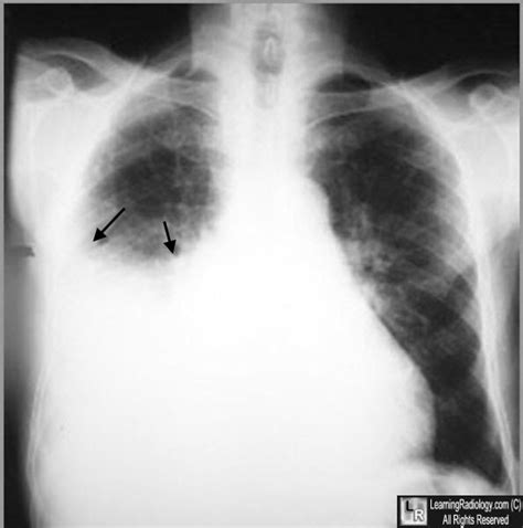 Learning Radiology Hydropneumothorax