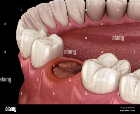 The Blood Clot Seals Off The Tooth After Extraction Medically Accurate