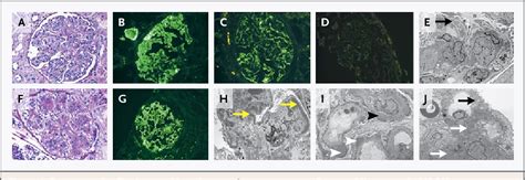 Figure 4 From Membranoproliferative Glomerulonephritis A New Look At