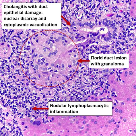 Florid Duct Lesion In Primary Biliary Cholangitis Pbc R Pathology