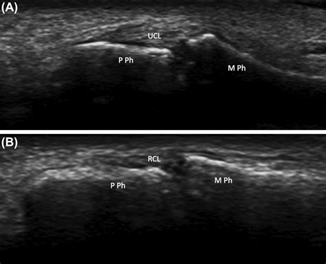 Ulnar Collateral Ligament Thumb Anatomy