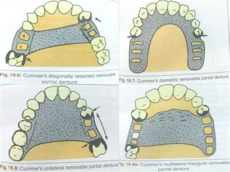 Introduction And Classification Of Removable Partial Denture