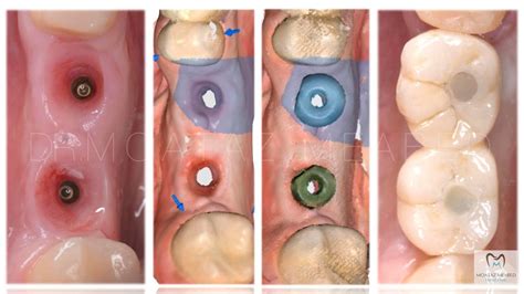 Roott R Pro Trate Implants Roott