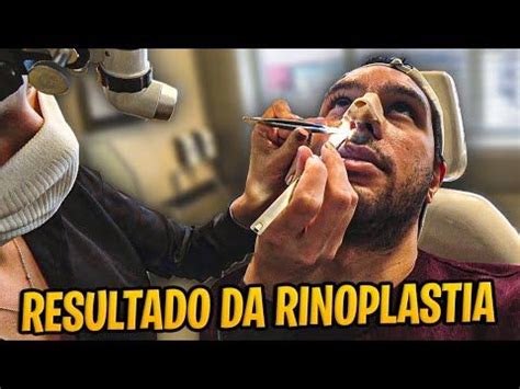 RETIREI O CURATIVO DO NARIZ RESULTADO DA RINOPLASTIA YouTube