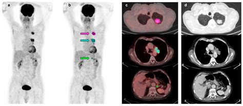 Diagnostics Free Full Text Heterogeneity Of Glycolytic Phenotype