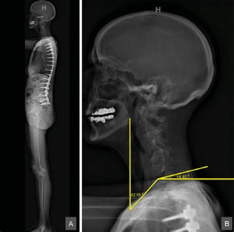 A Whole Body Lateral Stereoradiography B Magnified Cervical Spine