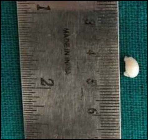 -Extracted supernumerary tooth. | Download Scientific Diagram