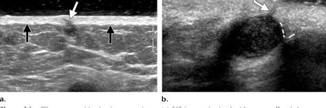 Figure 1 From Distinguishing Breast Skin Lesions From Superficial