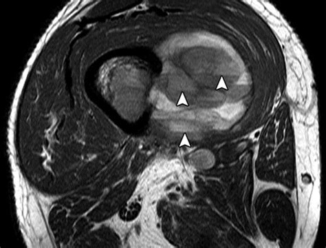 Telangiectatic Osteosarcoma Radiologic And Pathologic Findings