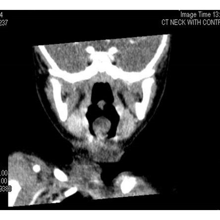 Flexible upper endoscopy showing a vallecular cyst obstructing the ...