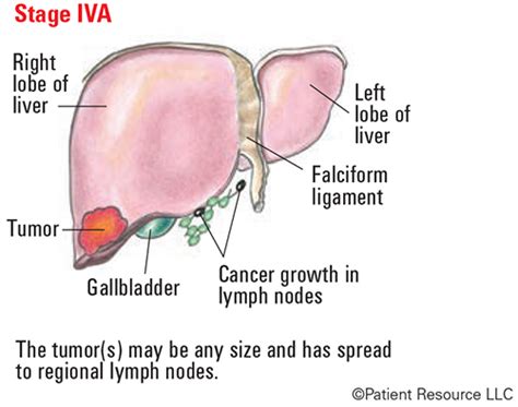 Liver Cancer Staging Systems