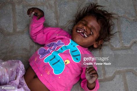 Facial Deformities Photos and Premium High Res Pictures - Getty Images