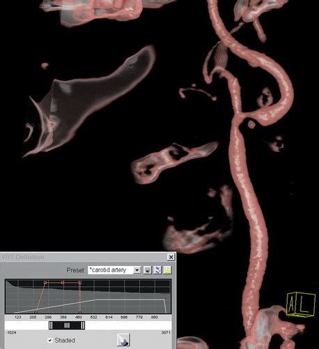 New Techniques In Ct Angiography Radiographics