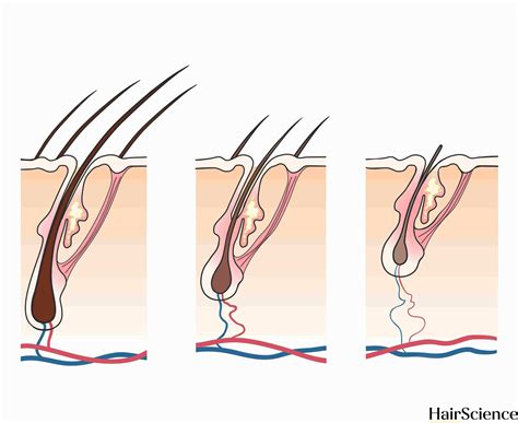 Hair Miniaturization A Sign Of Androgenic Alopecia HairScience