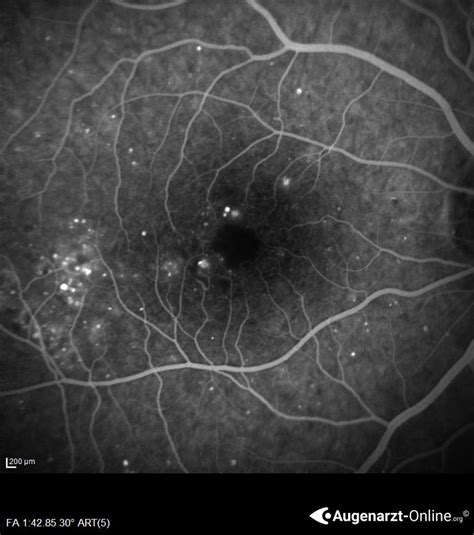 Diabetische Retinopathie Atlas Der Augenheilkunde