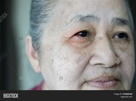 Diseases Retina Eye. Image & Photo (Free Trial) | Bigstock