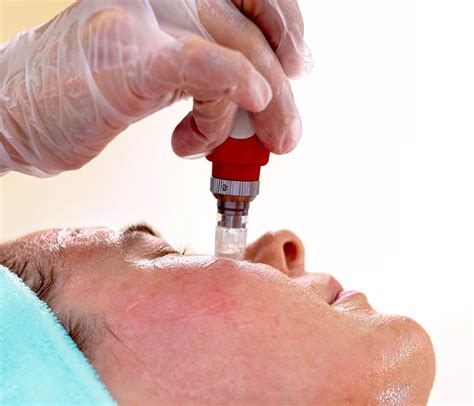 Microneedling Under The Eyes Procedure Cost And More