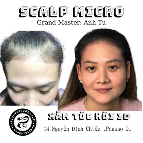 Master Anh T B C Th Y Ngh Thu T X M Tr Nh Di N K Thu T Scalp Micro