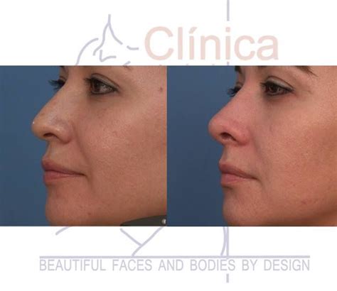 Pin By Marura On Nose Rhinoplasty Nose Surgery Facial Fillers