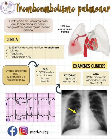 Tromboembolismo Pulmonar Resumen Enfermedades Salud UDocz