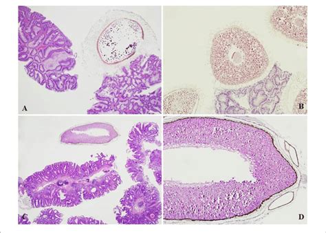 | (A) Tomato seed found adherent to a colorectal tubulo-villous adenoma... | Download Scientific ...