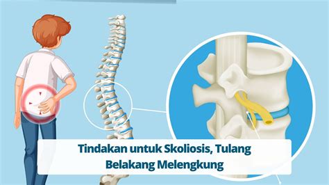 Tindakan Untuk Skoliosis Tulang Belakang Melengkung Primaya Hospital