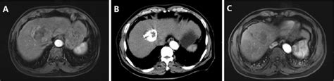 Complete Ablation Of Hcc A Mri Image Before Tace B Ct Image Before