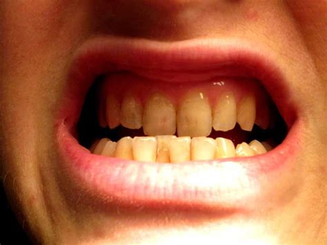 Bite Per Denti Stop Ai Disturbi Mandibolari Con Questo Sistema