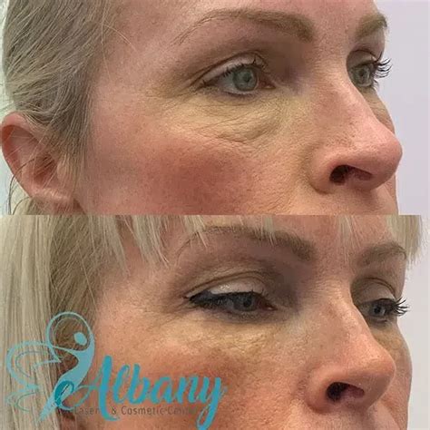 Tear Trough Fillers Case No Albany Cosmetic And Laser Centre In