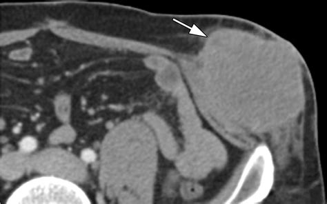 Imaging Of Abdominal Wall Masses Masslike Lesions And Diffuse Processes Radiographics