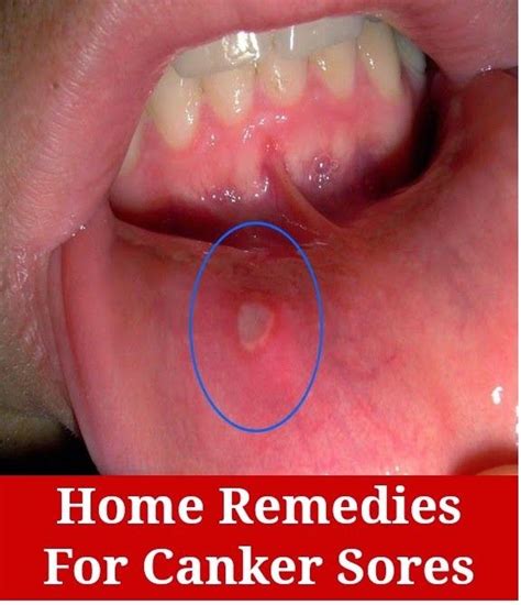 Stuttering Home Remedies: Sore Gums Dentures Home Remedies