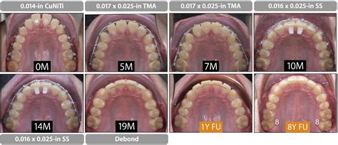 Class Ii Malocclusion With Severe Overjet Treated With Maxillary Second