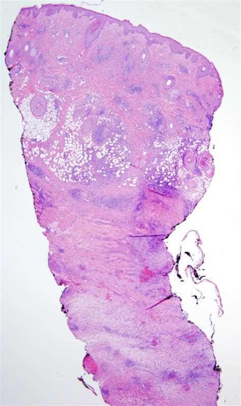 Myiasis | Dermatopathology