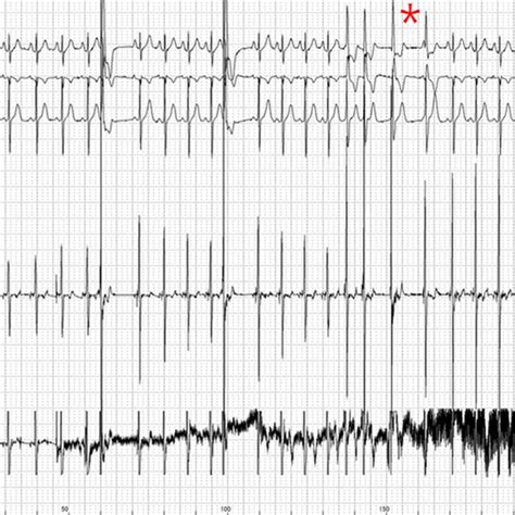 A A Twelvelead Electrocardiography Showing Normal Sinus Rhythm With