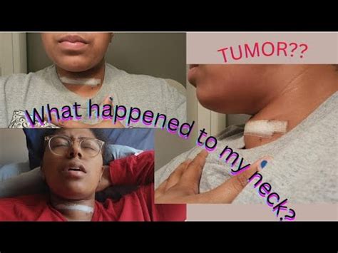 Why Is My Neck Cut Open My Thyroidectomy Experience My Healing