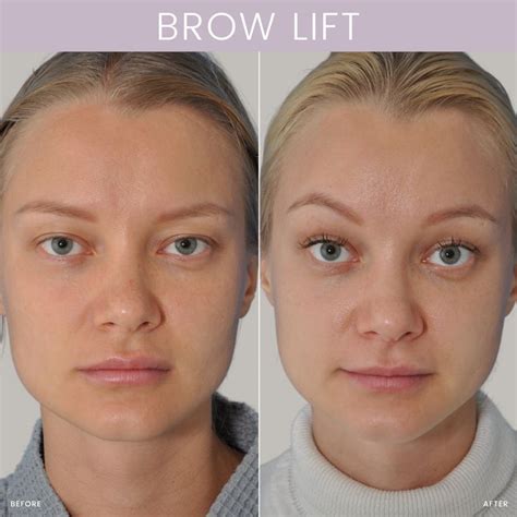 Brow Lift Before And After Artofit