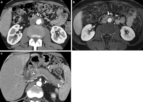 A 62 Year Old Male With A History Of Common Bile Duct Stent Placement