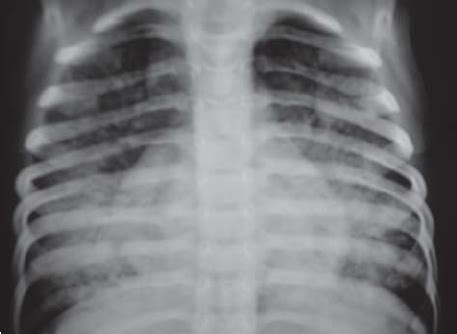 Chest Radiograph Postero Anterior View Showing Bilateral Opacities In