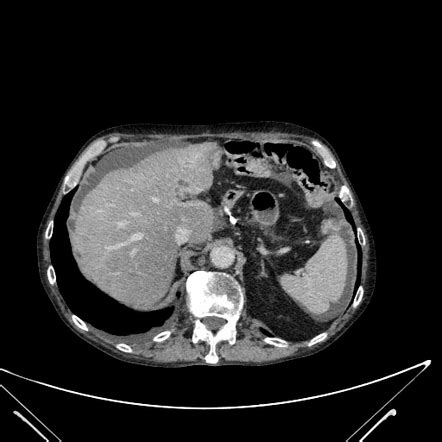 Peribiliary Cyst Radiology Reference Article Radiopaedia Org