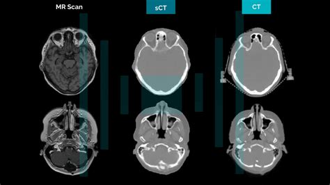 Deep Learning To Generate Synthetic CT Images From MR For Radiotherapy