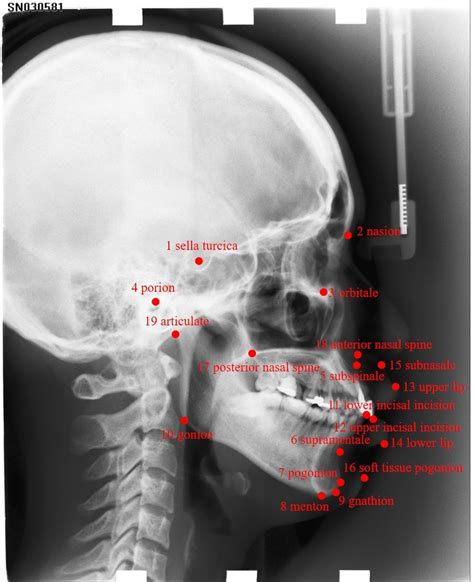 All 19 landmarks on x-ray images which we aim to detect. | Download ...